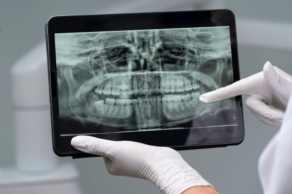 Can Dental X-Rays Detect Oral Cancer or Hidden Infections?
