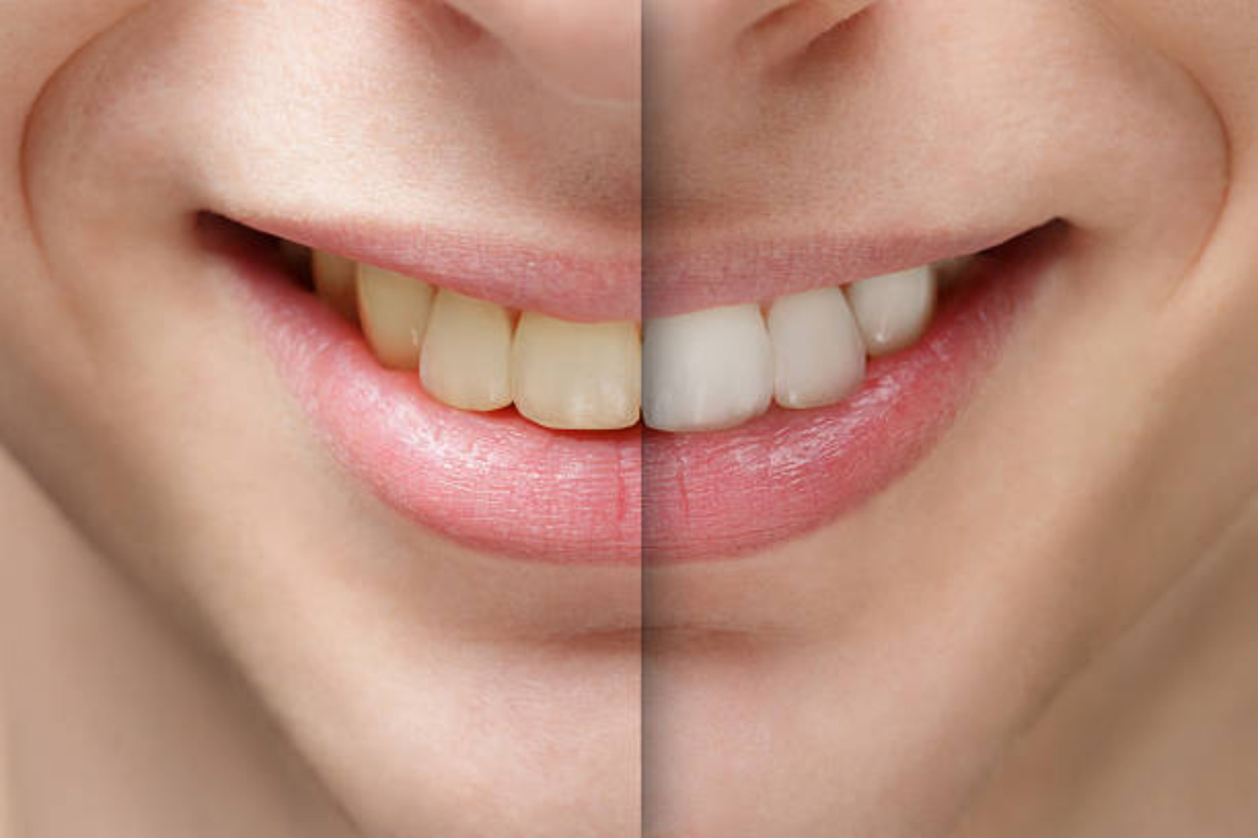 Before and after smile makeover results in Miami