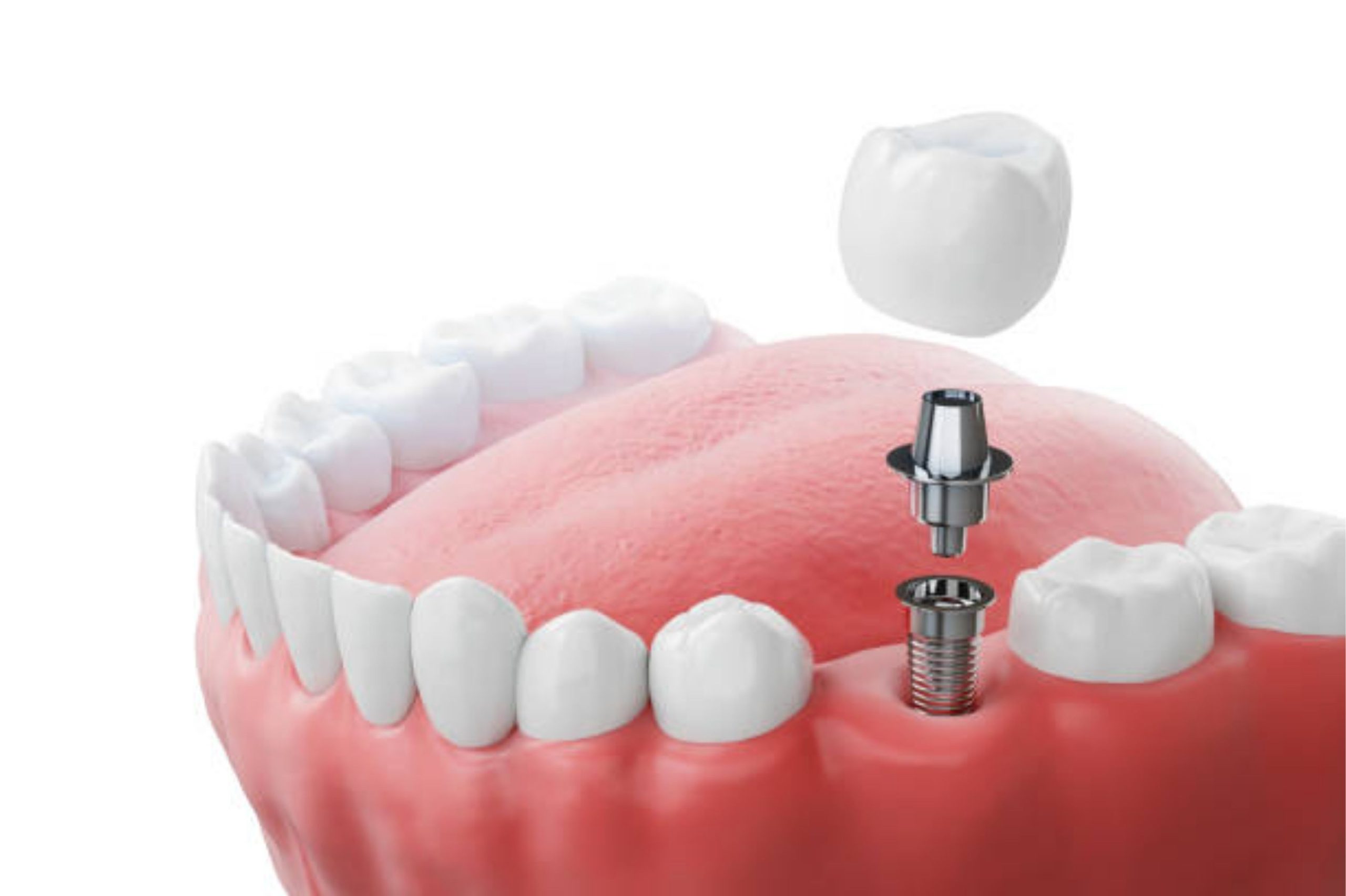 Dental implant post and crown model demonstration