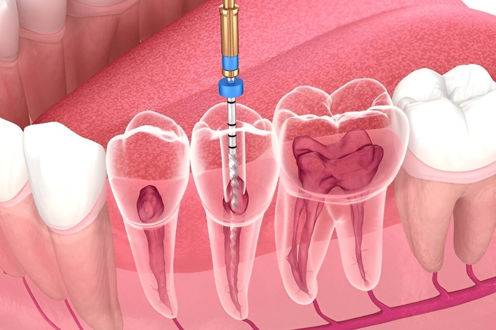 What Is Endodontic Treatment and How Does a Root Canal Work?